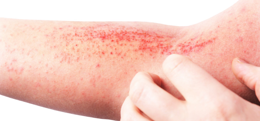 dermatitis atopica granada